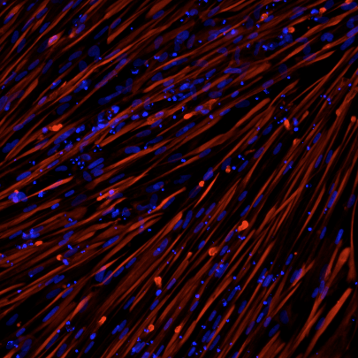 ioSkeletal Myocytes DMD Exon 45 Deletion